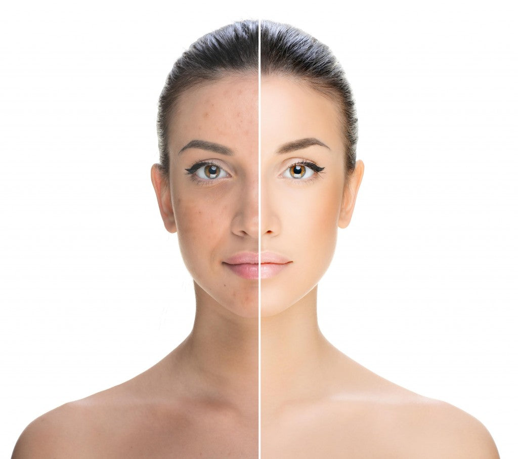 Comparaison avant-après d'un visage féminin, teint terne et imperfections à gauche, peau lumineuse et uniforme à droite